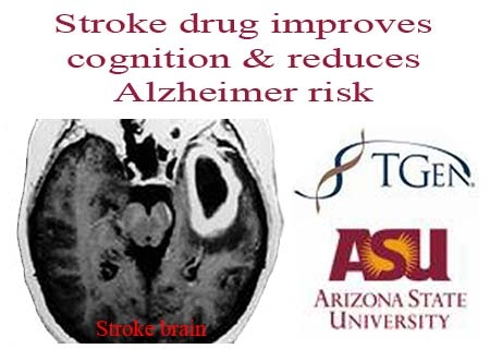TGEN, ASU logos and stroke suffered brain
