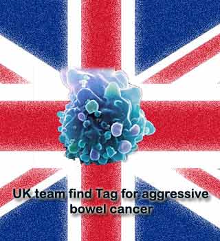 UK,Bowel Cancer Cell