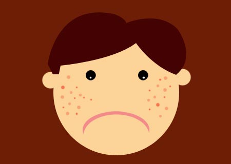 Acne and Homoeopathy