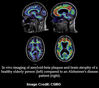 Amyloid Beta Plaques
