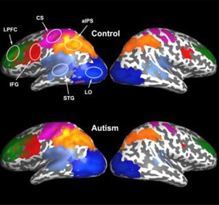Autistic Brain Weak Sync