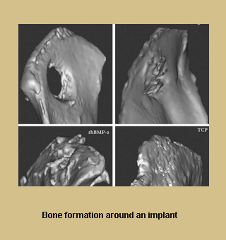 Bone Formation Implant