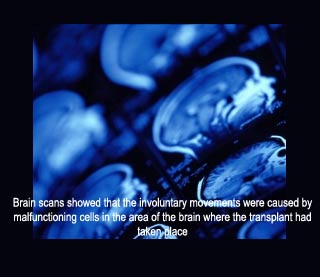 Brain scans Parkinsons