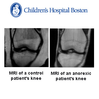 CHB MRI  Knee