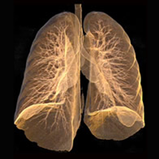 Emphysema Lung