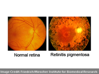 Friedrich Normal Retina
