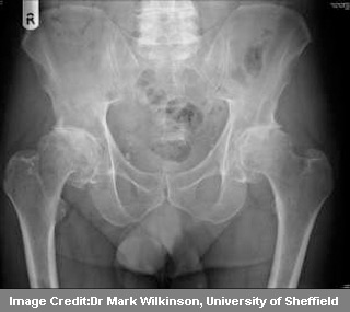 Hip Osteoarthritis X-Ray