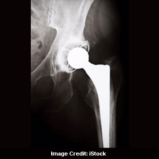 Joint Replacement Failure