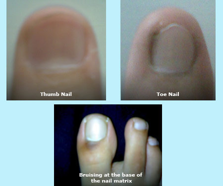 Nail Infections