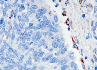 Small Cell Lung Cancer