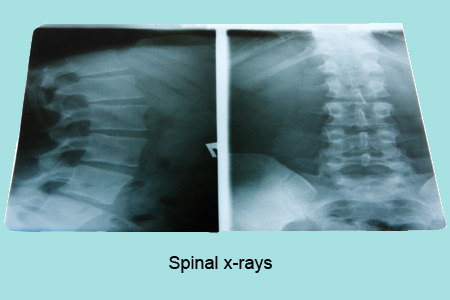 Spinal X-rays